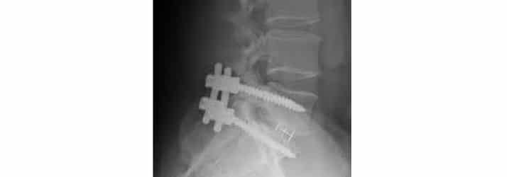 Chiropractic Winnebago IL Neck X-Ray Chiropractic Care for Athletes