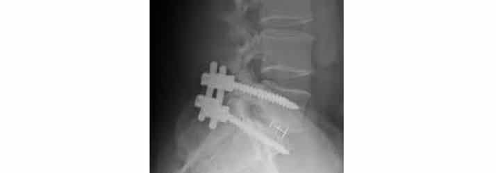 Chiropractic Winnebago IL Neck X-Ray Chiropractic Care for Athletes Chiropractic Winnebago IL Neck X-Ray Chiropractic Care for Athletes